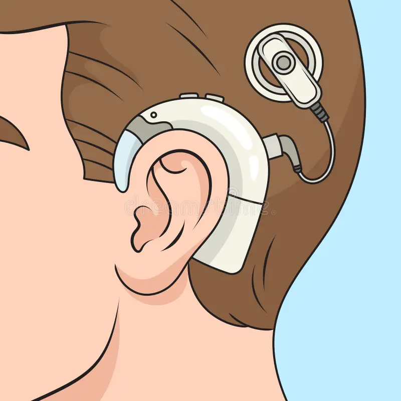 Cochlear Implant
